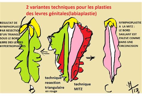 Hypertrophie des lèvres vaginales : Nymphoplastie médicale ou。